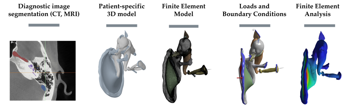 In-Silico Model for Ossicular Chain Reconstruction of the Middle Ear