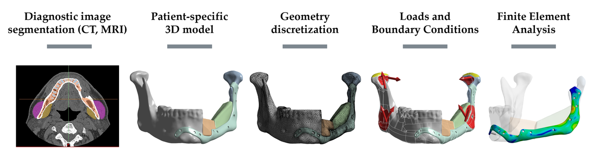 In-Silico Model for Mandibular Reconstruction